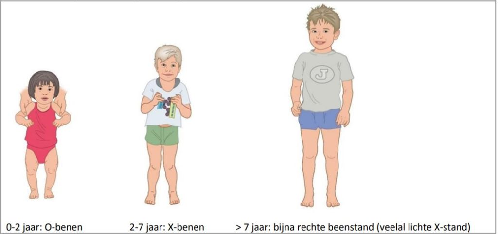 Illustratie van de veranderende stand van de benen bij opgroeiende kinderen